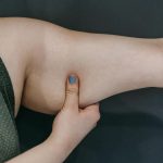 lifting des bras peau tombante